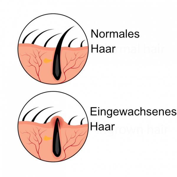 Eingewachsene Haare an den Beinen Behandlung und Tipps HIER